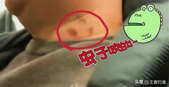 脖子上草莓印怎么在一晚消除，脖子上的草莓印一晚上能消除